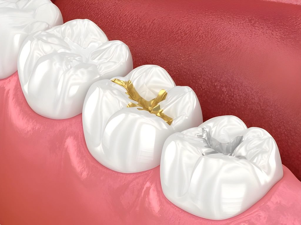 dental fillings near you